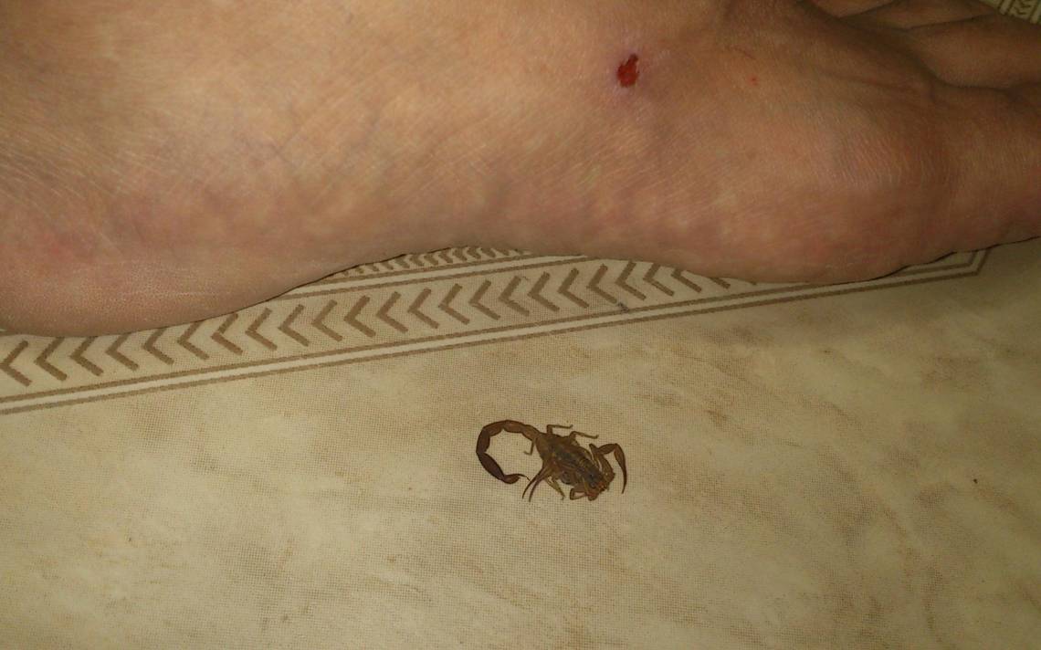 Dolorosas picaduras de escorpión